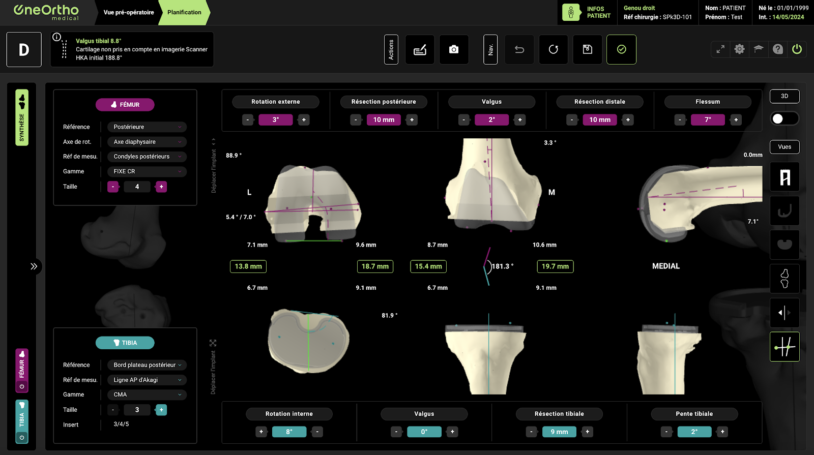 Vue sur des os dans l'interface OneOrtho