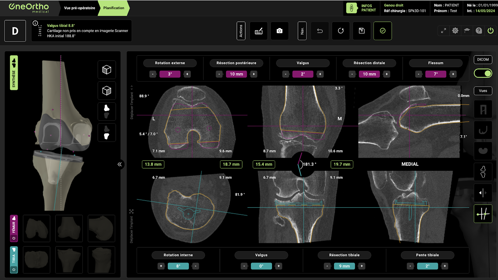 Vue sur des os plus complexes dans l'interface OneOrtho