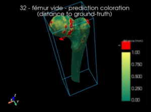 Évaluation de la précision de la reconstruction 3D des os du modèle IA comparée à l’annotation de l’expert chirurgical (carte de distance)