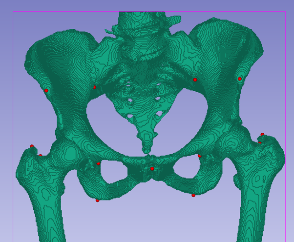 Positionnement des points anatomiques par l’IA pour la pose de prothèse de hanche